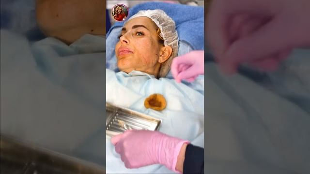 Контурная пластика лица. Канюля. Уплотняем и повышаем тонус кожи