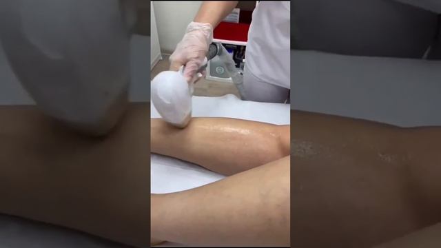 Лазерная эпиляция лица и тела в центре косметологии Софт Эпил, лазерная депиляция, эпиляция лазером.