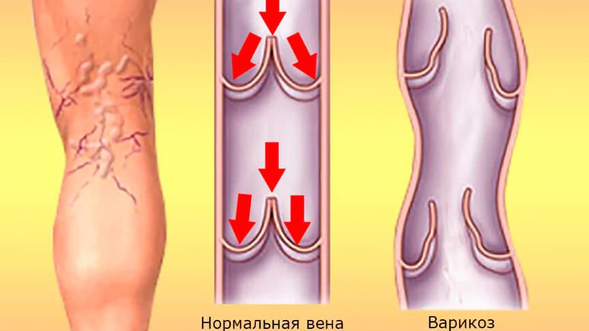 Варикозная Вена На Члене