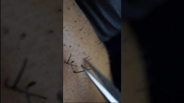 Пинцетом для удаления вросшей бороды for iPhone 2020/11/22