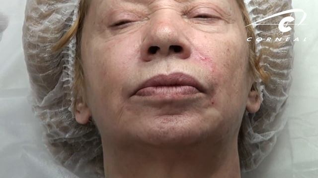 Контурная пластика для среднего медицинского персонала