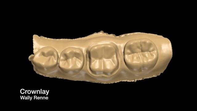 Posterior tooth preparations inlay onlay crownlay and crown