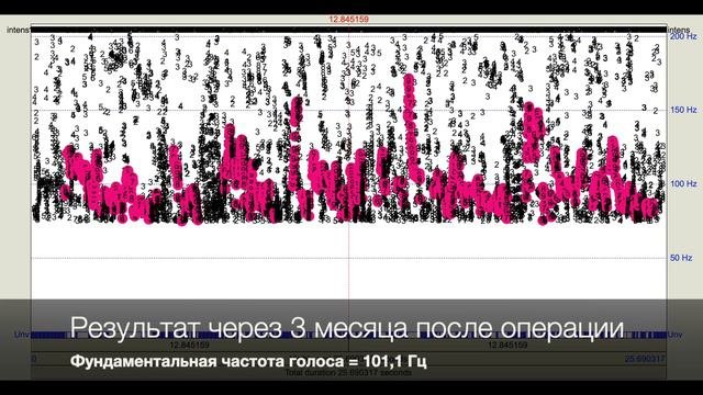 3 месяца после тиреопластики 3 типа. Хирурги - Будейкина Л.С., Миндлин С.Н., Чучкалова Ж.А.