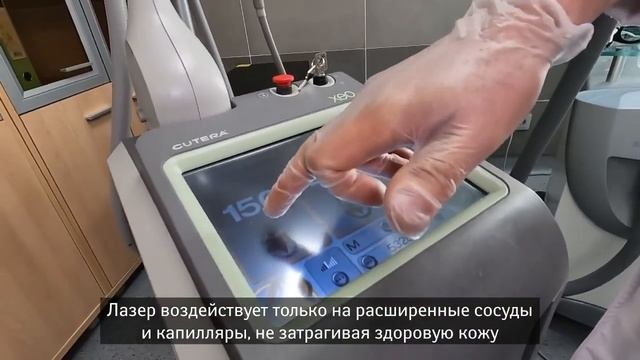 Современный лазерный метод лечения сосудистых звездочек