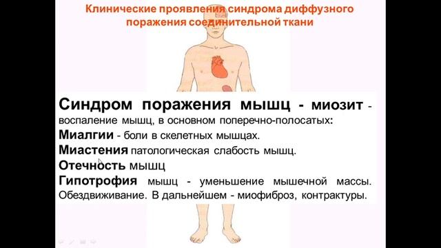 Синдром системного воспаления соединительной ткани / Токтогулова Нургуль