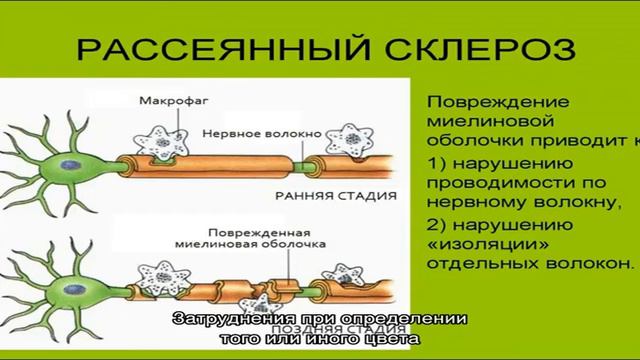 Рассеянный склероз: основные симптомы, причины развития заболевания, профилактика, лечение