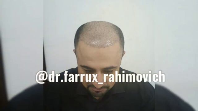 instagram dr.farrux_rahimovich пересадка волос соч экиш soch ekish