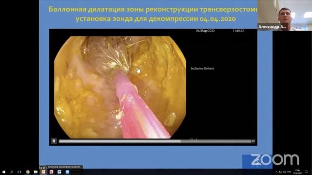 1 Федоренко А.А Павлов П.В Восстановление непрерывности толстой кишки спустя 25 лет после колостоми