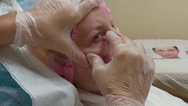 Заполнение носослезной борозды с применением канюли.