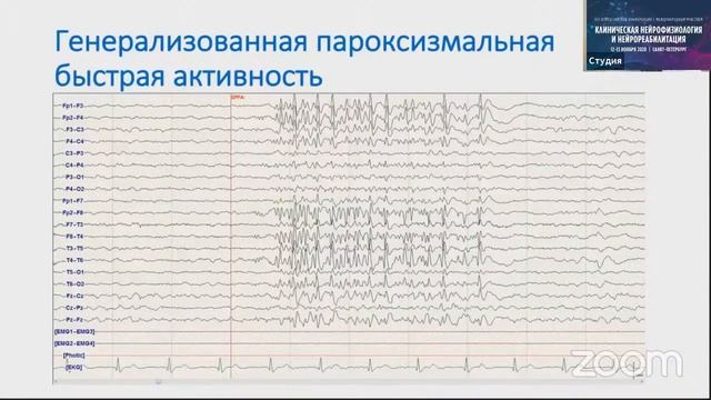 Особенности ЭЭГ при приступах с генерализованным началом. Ноговицын В Ю  Москва.