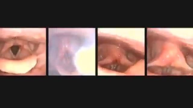Vocal Cords up close while singing