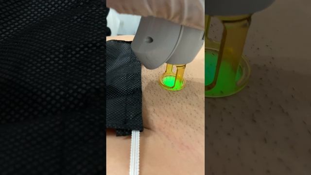 Laser Hair Removal at SEV✨ ( DISCLAIMER: This client was unshaven due to video purposes )