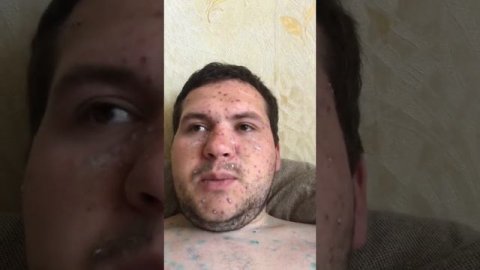 Чем лечусь при ветрянке