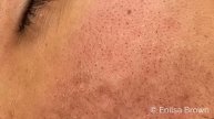 Blackhead & Whitehead Extractions on "K" Part 4