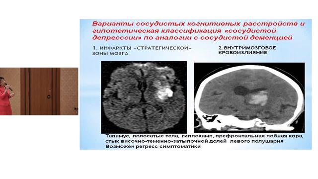 Некоторые особенности ведения больных, перенесших инсульт