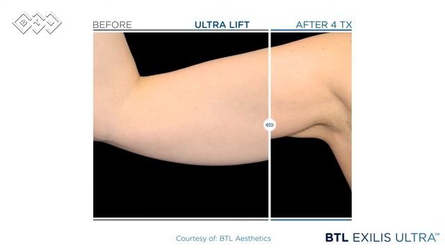 Exilis Ultra before and after photos