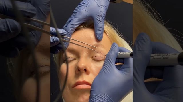 Upper Blepharoplasty + Brow Lift - 1 Week Results - Dr. Anil Shah