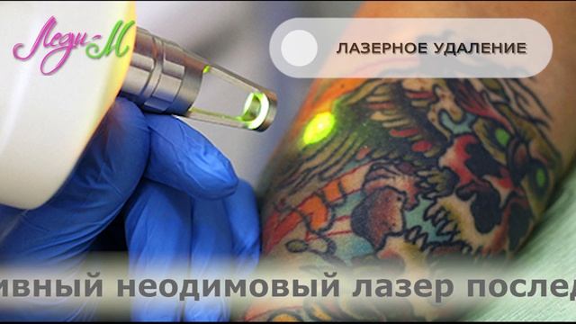 Леди М Лазерное удаление