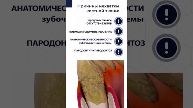 Костная пластика перед имплантацией зубов: нужна или нет? Часть 1. Тизер.