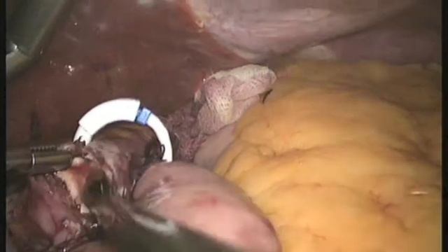 Roux-en-Y Banded (Fobi`s RIng) Gastric Bypass- Dr Atul Peters (Bariatric and Metabolic Surgery)