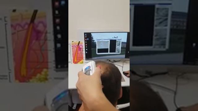 Псориаз на голове
