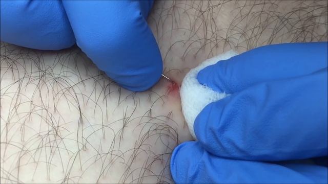 Ingrown Hair Removal on Mans Leg