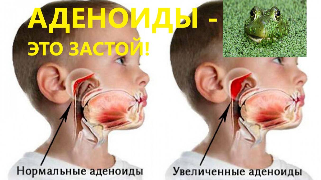 Аденоиды у детей. Причины. Рассказывает остеопат.