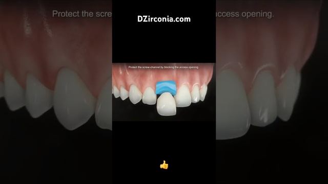 DZirconia.com установка переднего имплантата сразу после удаления зуба. #стоматология #имплантация