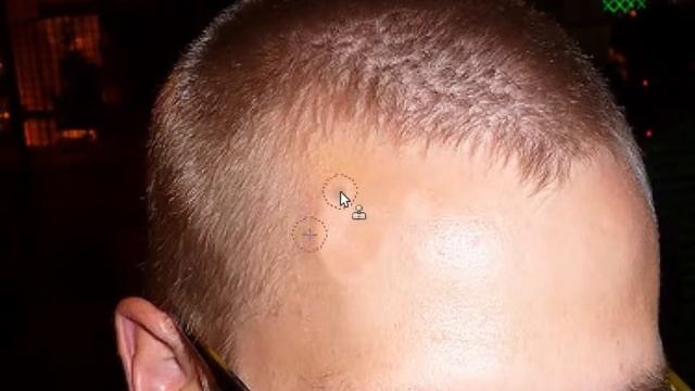 how to get rid of a zit or pimple-gimp