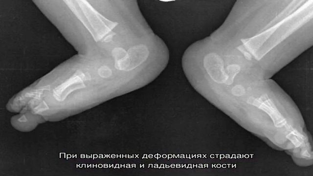 Варусная деформация нижних конечностей