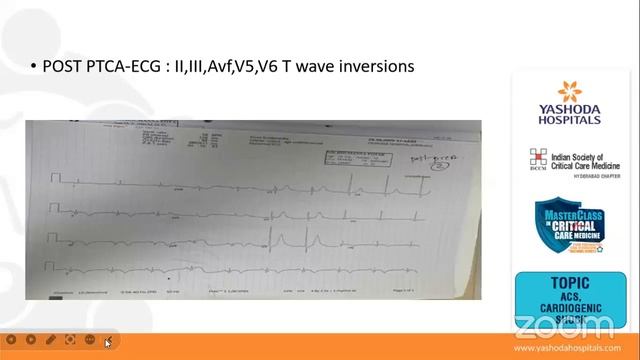 Webinar Topic: ACS, Cardiogenic Shock | Yashoda Hospitals Hyderabad