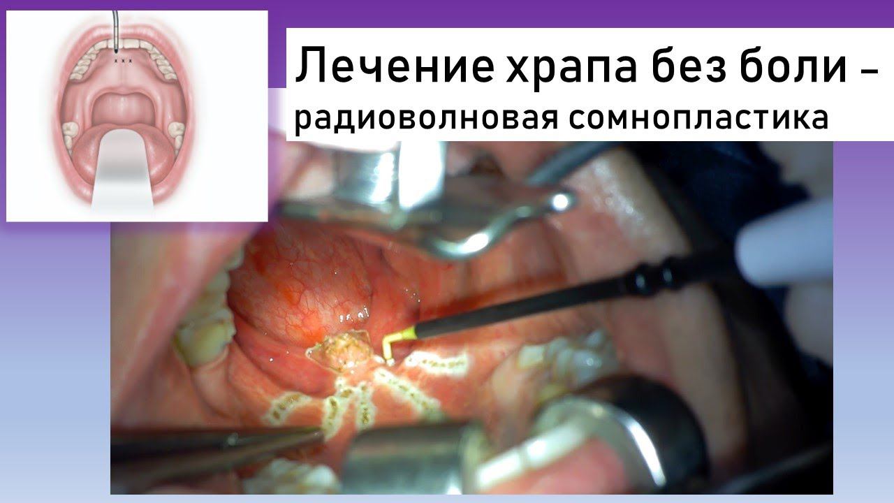Хирургия храпа, СОАС: радиоволновая резекция нёбного язычка и насечки на нёбе, увулопалатопластика.