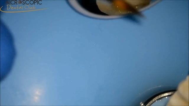 Class II Composite Restoration
