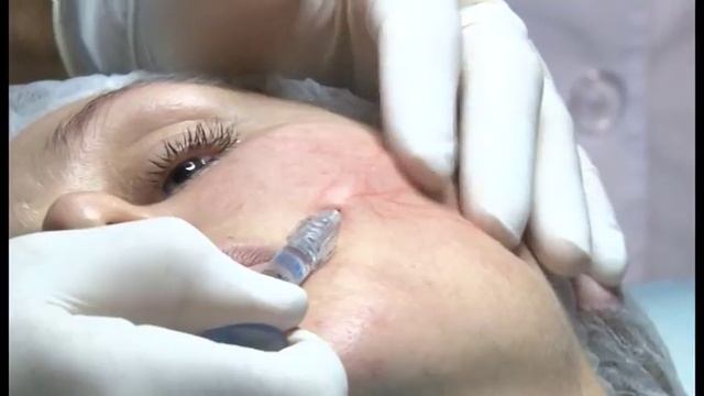 Инъекционная терапия - революция в сфере красоты