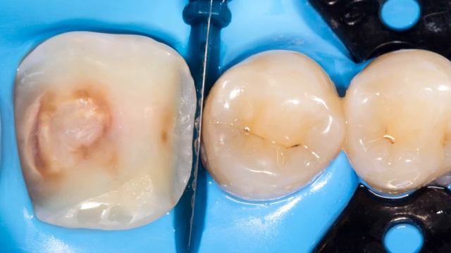 Керамическая накладка на зуб в одно посещение . #стоматология #стоматолог#кариес #виниры #имплант