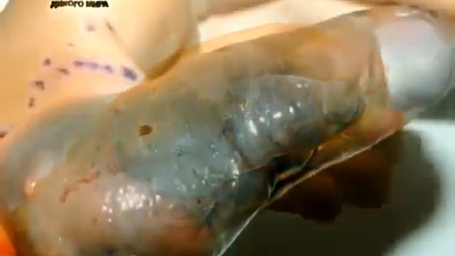 Укус шпильковой змеи истории людей