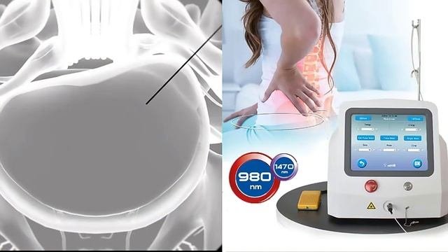 9801470nm Diode Laser For Percutaneous Laser Disc Decompression