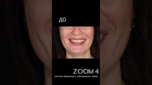 Отбеливание зубов ZOOM. Смотрим результат!