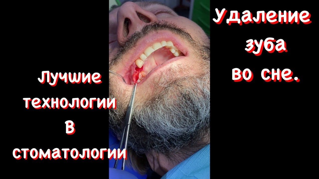 Удаление зуба под седацией.