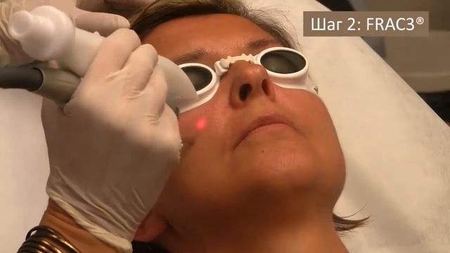 Fotona 4D неинвазивный лазерный фейс лифтинг