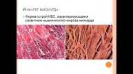 Слесарева Е.В. Патологическая анатомия ИБС 8.12.2021
