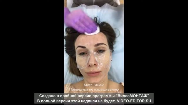 Инъекционная процедура наращивание фибропластов