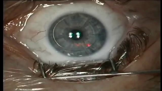 Лазерная Коррекция Зрения - видео операции