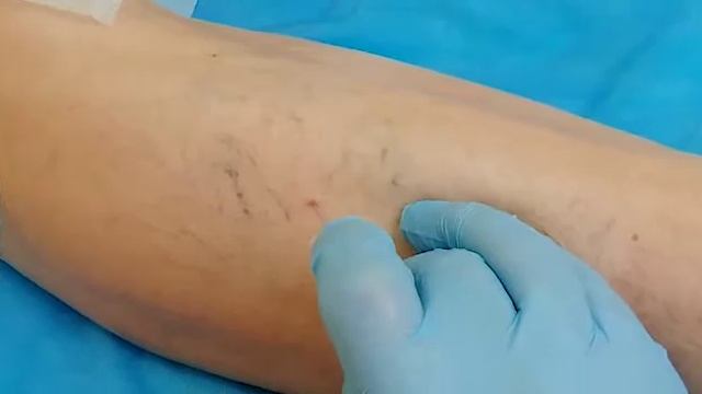 АРД-КЛИНИК. Удаление сосудистых звездочек