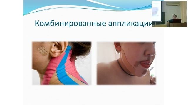 Кинезиотейпирование в логопедической практике