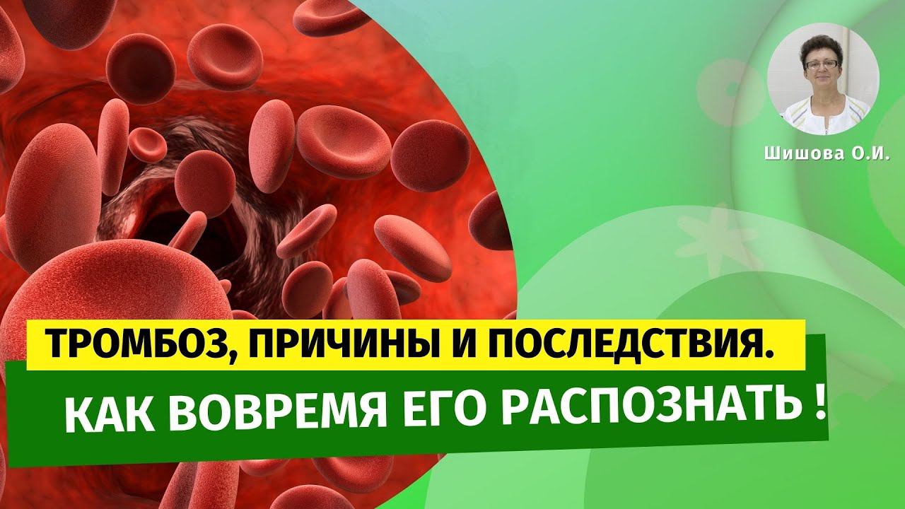 Тромбоз, причины и последствия. Как вовремя его распознать. [Шишова О.И.]