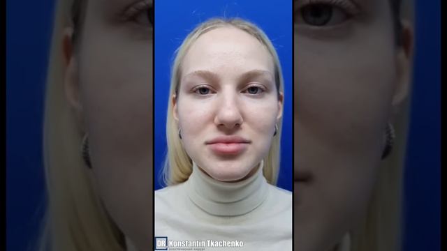 До и после РИНОПЛАСТИКИ 😯#ринопластика #риносептопластика #ринопластикамосква
