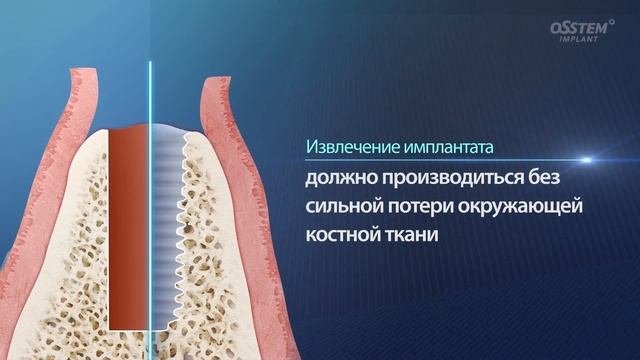 EFR Kit Набор для удаления имплантата