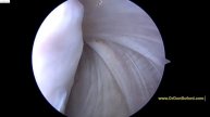 R Shoulder Rotator Cuff Repair and Biceps Tenodesis 2018 02 01 AT