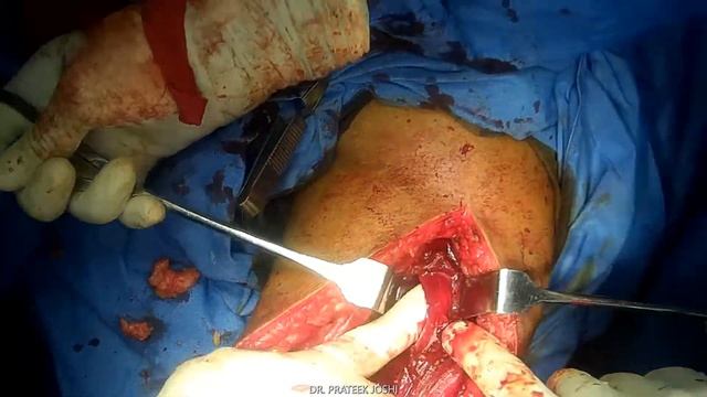 Humerus Fracture | Triceps Split Approach | Humerus Platting | Dr. Prateek Joshi